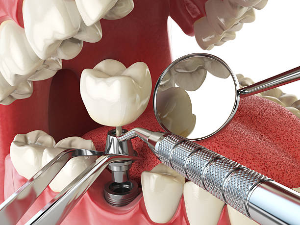 Best Emergency Tooth Extraction in Middletown, DE